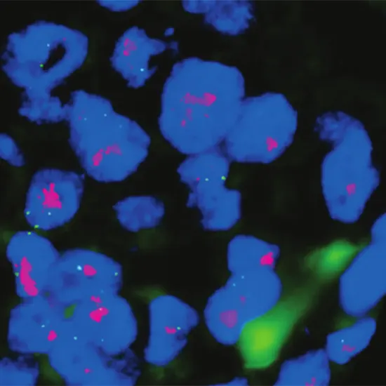 FISH, Her-2 Neu Oncogene Amplification, Breast Cancer
